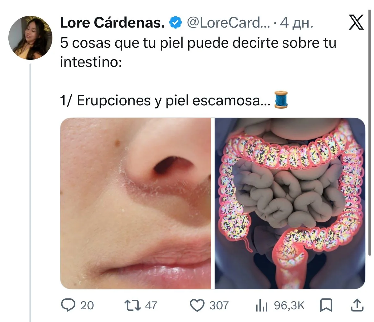 Пять признаков проблем с кишечником, которые выдаёт ваша кожа